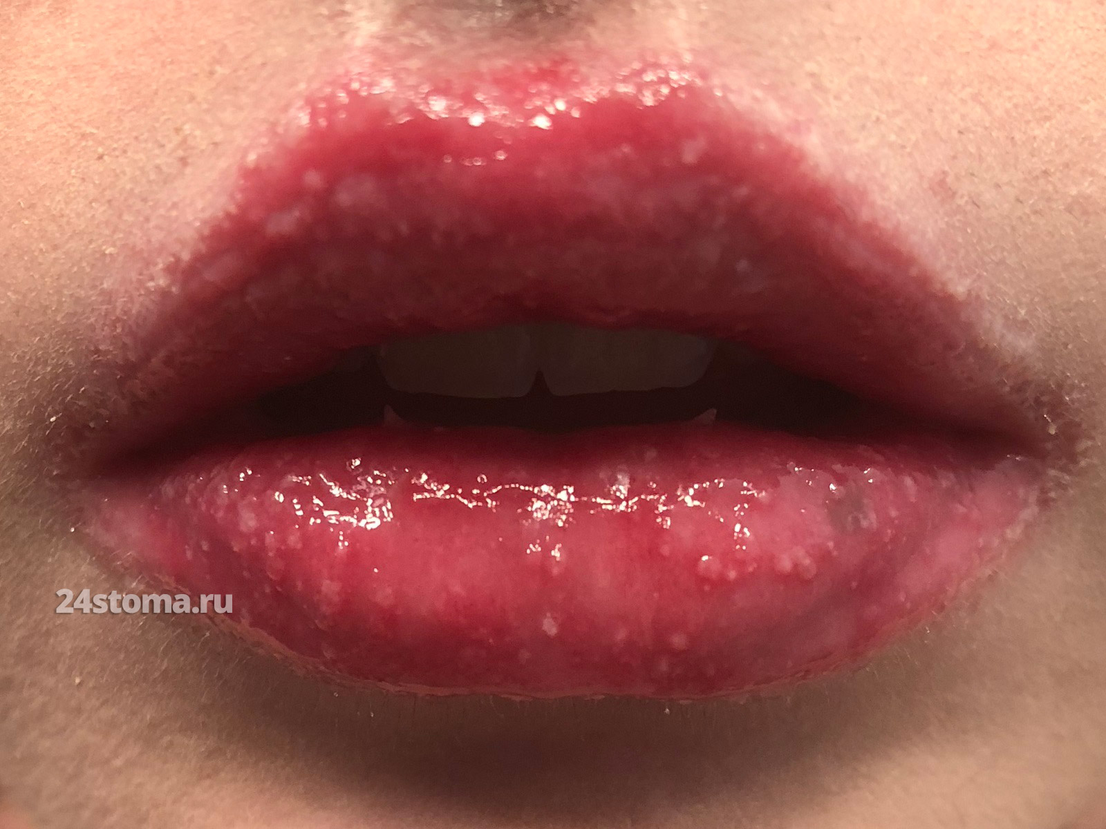 Хейлит губ (начался через 15 дней с начала приема таб. изотретиноина)