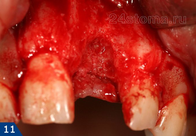Исходная ситуация: дефект костной ткани в области удаленного зуба