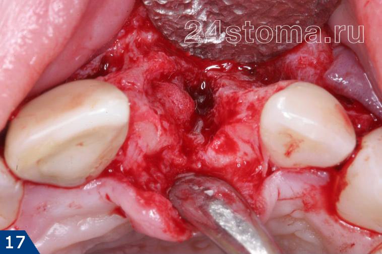 Исходная ситуация: костный дефект в области ранее удаленного зуба
