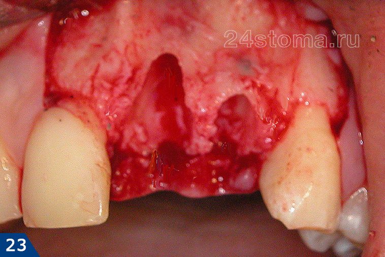 Исходная ситуация: дефекты костной ткани в области удаленных зубов