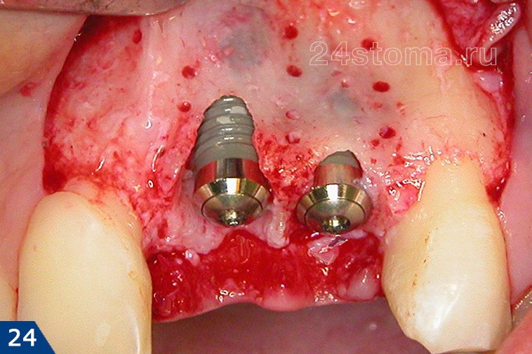 Проведена установка двух имплантов в лунки ранее удаленных зубов