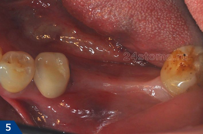 Исходная ситуация: узкий альвеолярный отросток нижней челюсти в области осутствующих 6-7 зубов