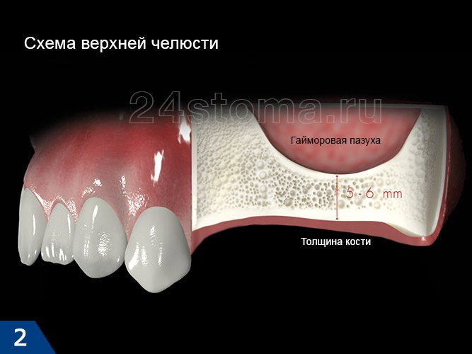 Опускание дна гайморовой пазухи в рбласти отсуствующих зубов (высота альверлярного отроска челюсти всего 5-6 мм, что недостаточно для установки имплантов) 