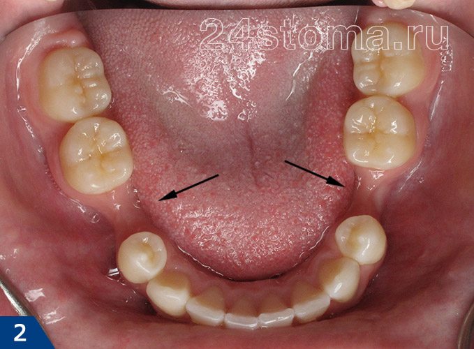Горизонтальная резорбция кости в области отсутствующих зубов (узкий альвеолярный отросток)