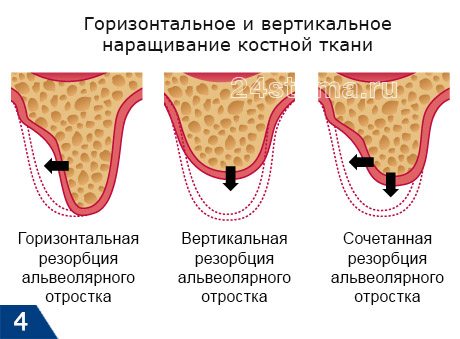 Типы резорбции кости (применительно к альвеолярному отростку верхней челюсти) 