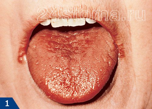 Сухость в полости рта - ксеростомия