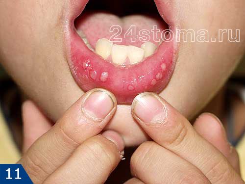 Герпетический стоматит на слизистой оболочке губы