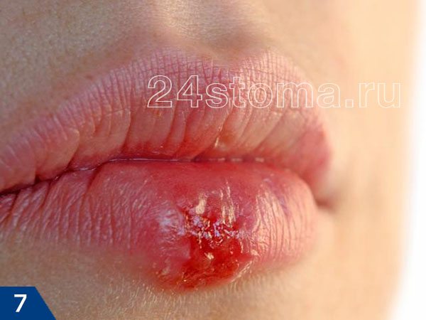 Герпетические пузырьки на губе лопаются с образованием большой мокрой "язвы"