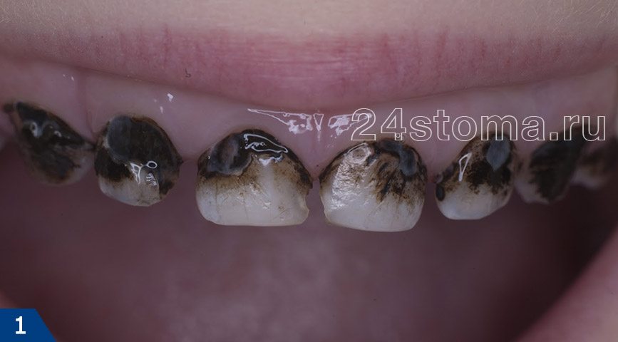 Вид зубов после серебрения