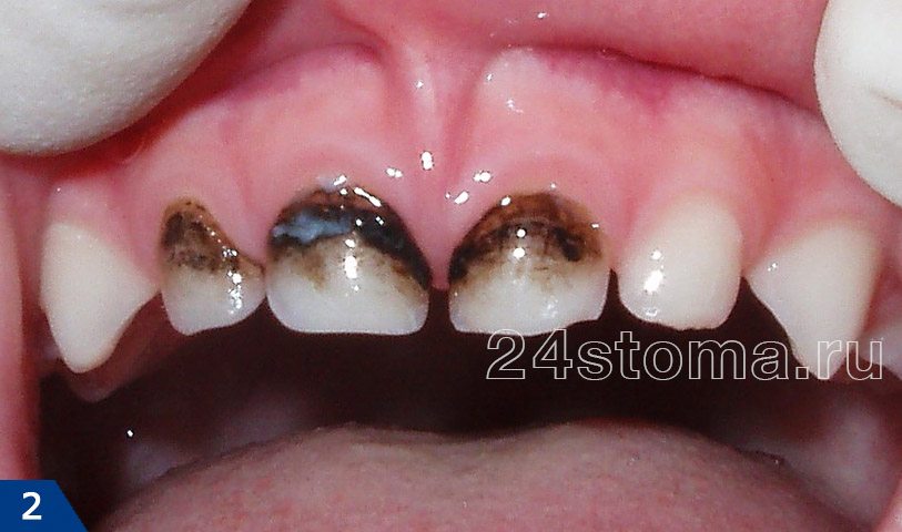 Серебрение молочных зубов Томск Красочный клиника давтяна