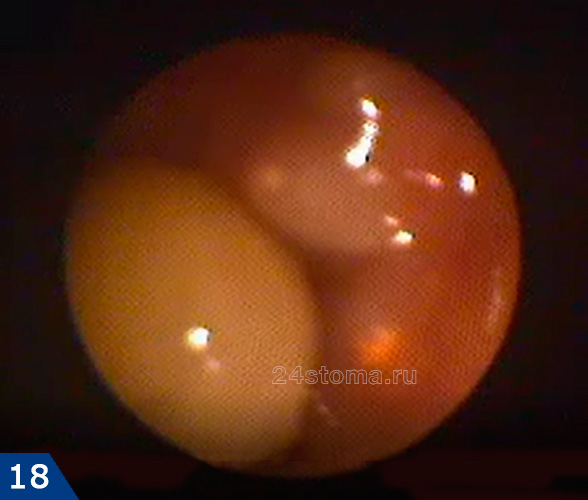 Эндоскопическая эндоназальная гаймороскопия: округлое образование желтого цвета - заполненная гноем киста; рядом визуализируются верхушки корней 7 моляра (покрытые одной лишь слизистой оболочкой)