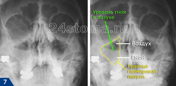Острый гнойный гайморит на рентгеновском снимке: хорошо виден уровень жидкости (уровень гноя в пазухе)