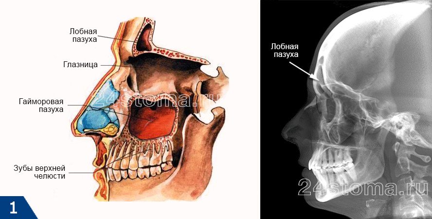 Лобная пазуха вид на схеме и на рентгеновском снимке черепа (вид сбоку)