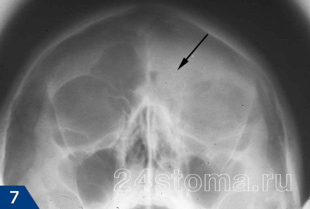 Рентгенография черепа: левосторонний гнойный фронтит (пазуха, заполненная гноем, указана стрелочкой; вторая пазуха здорова)