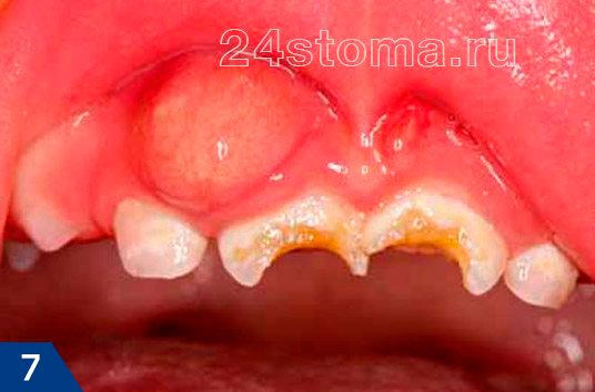 Гнойный абсцесс на десне (при периодонтите), возникший в проекции разрушенных кариесом зубов