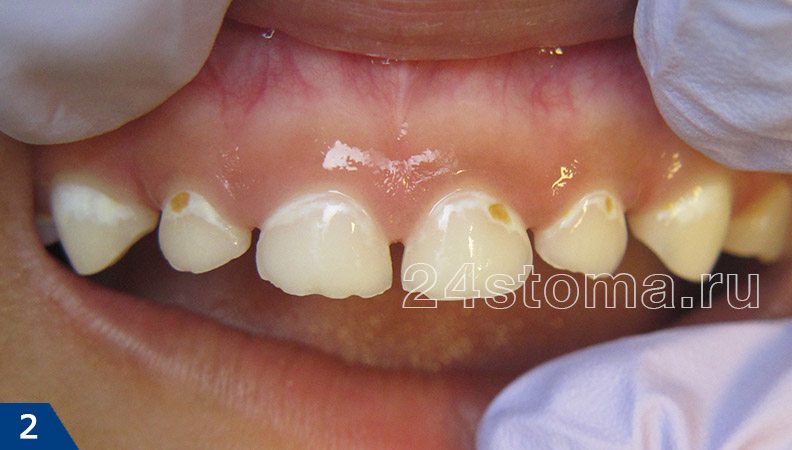 В пришеечных областях всех верхних зубов - кариес в стадии белого пятна, плюс 3 небольших поверхностых кариеса
