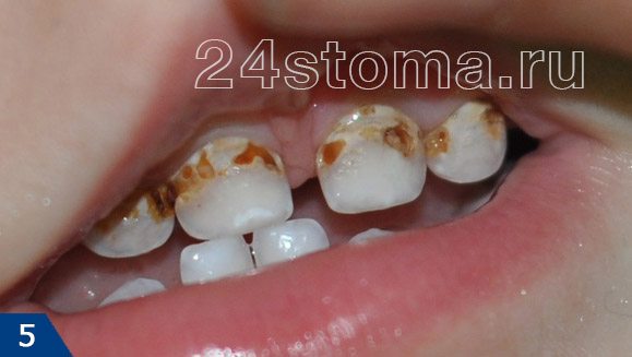 Лечение кариеса зубов у ребенка 3 лет thumbnail