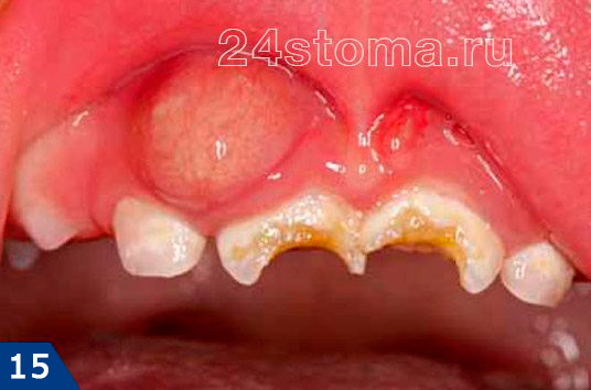 Гнойный абсцесс на десне (при периодонтите), возникший в проекции разрушенных кариесом зубов