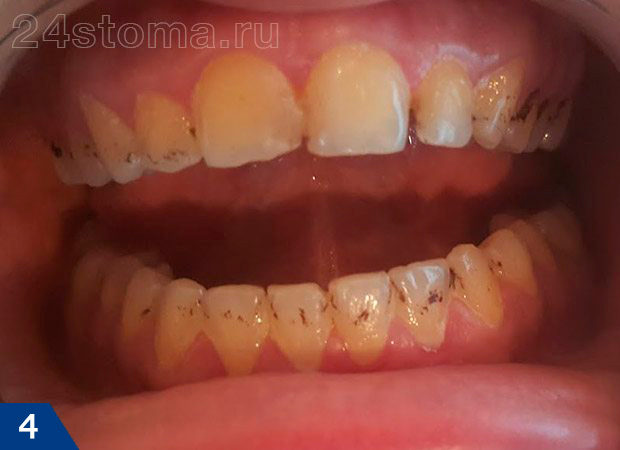 Черный пигментный налет на зубах у ребенка, появившийся в результате жизнедеятельности хромогенных бактерий (актиномицетов)