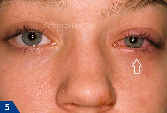 Герпетический конъюнктивит у ребенка (пораженный глаз отмечен стрелкой)