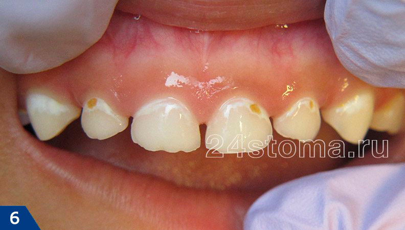 В пришеечных областях всех верхних зубов - кариес в стадии белого пятна, плюс 3 небольших поверхностных кариеса