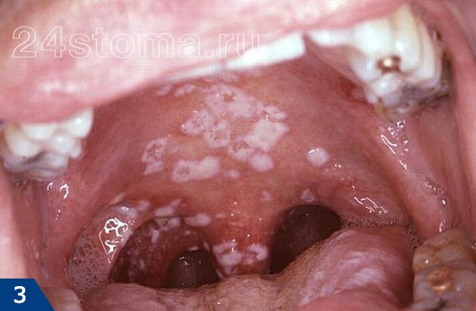 Кандидоз полости рта (белые бляшки, локализованные в разных участках полости рта)
