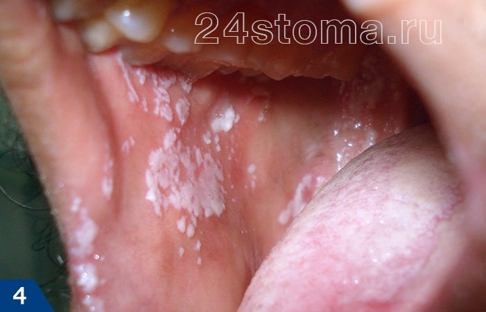 Кандидоз полости рта (белые бляшки, локализованные в разных участках полости рта)