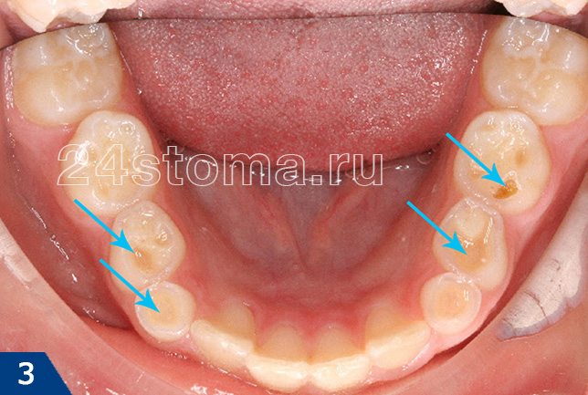 Стирание жевательных поверхностей нижних зубов у ребенка (места повышенно стирания указаны стрелочками) в результате бруксизма