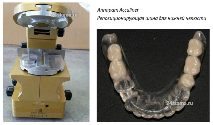 Аппарат «Acculiner» и изготовленная на нем репозиционирующая шина для нижней челюсти