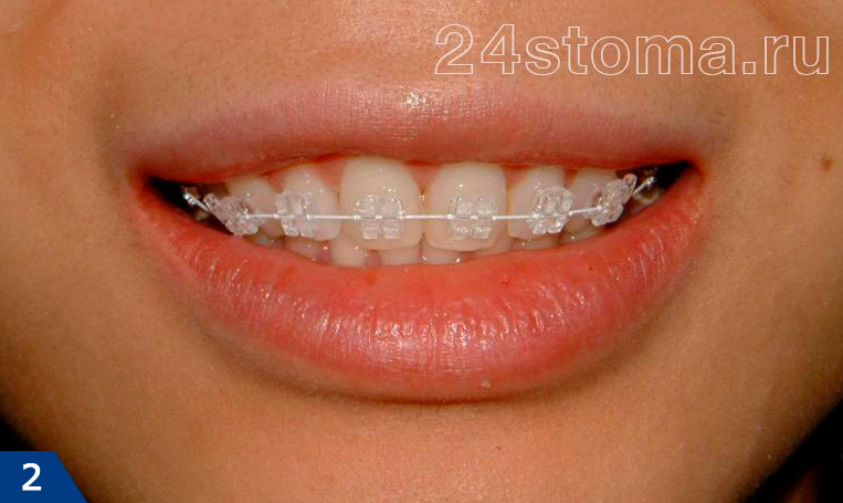 Сапфировые брекеты в ортодонтии