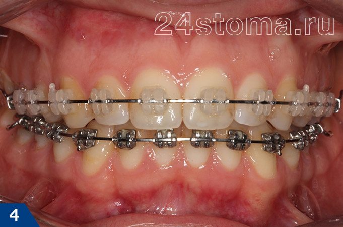 Керамические брекеты на верхних зубах и металлические брекеты на нижних зубах