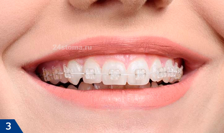 Сапфировые брекеты в ортодонтии
