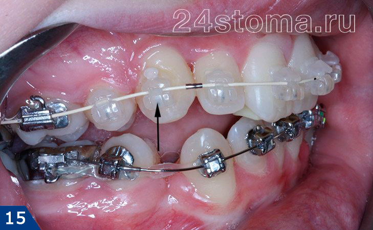 Безлигатурный тип фиксации при помощи замкового механизма (у сапфировых брекетов на верхних зубах)