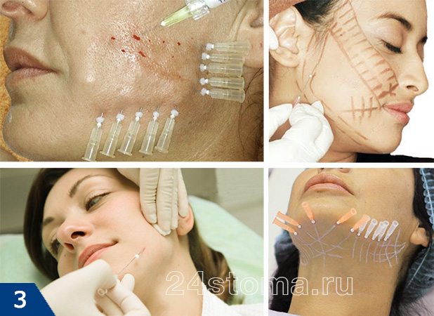 Процесс имплантации мезонитей в дермальный слой кожи