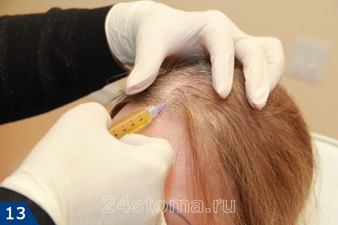 Инъекции обогащенной тромбоцитами плазмы в волосистую часть головы