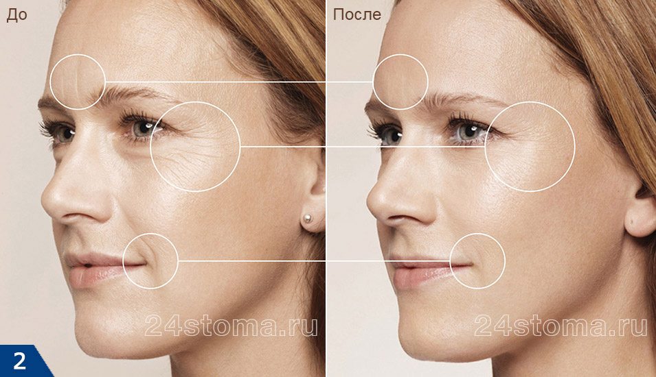 Применение филлеров на лице: фото до и после