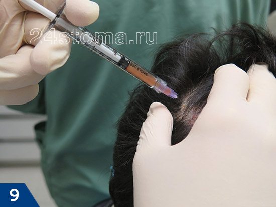 Введение плазмы путем внутрикожных или подкожных инъекций в области лица или волосистой части головы