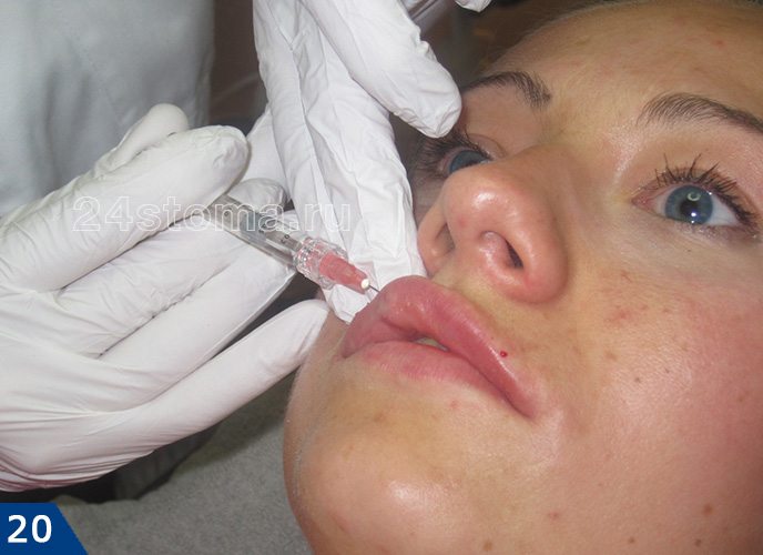 Инъекция геля гиалуроновой кислоты для увеличения объема губ
