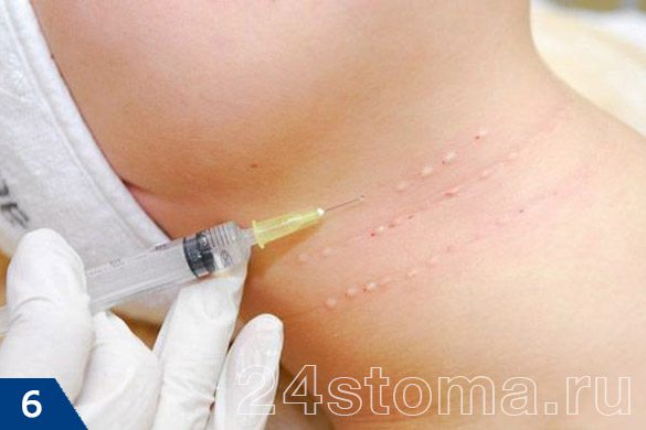 Биоревитализация кожи инъекциями гиалуроновой кислоты