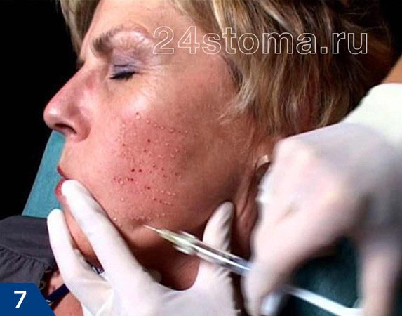 Биоревитализация кожи лица инъекциями гиалуроновой кислоты