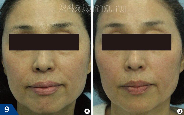 Биоревитализация кожи лица гиалуроновой кислотой: фото до и после