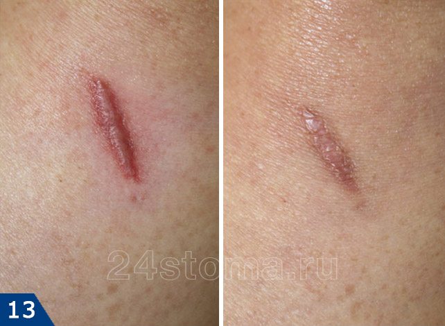 Удаление гипертрофического шрама лазером: фото до и после (проведено 7 процедур; фото "после" сделано через 2 недели после последней процедуры)