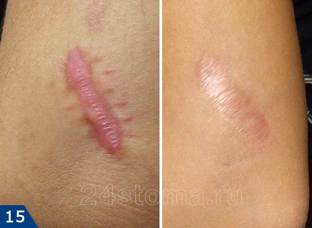 Удаление плоского шрама лазером: фото до и после
