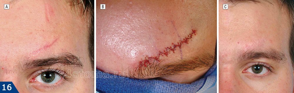 Хирургическое удаление шрама на лбу: фото до и после