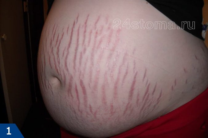 Растяжки при беременности (только что образовавшиеся растяжки фиолетового цвета)