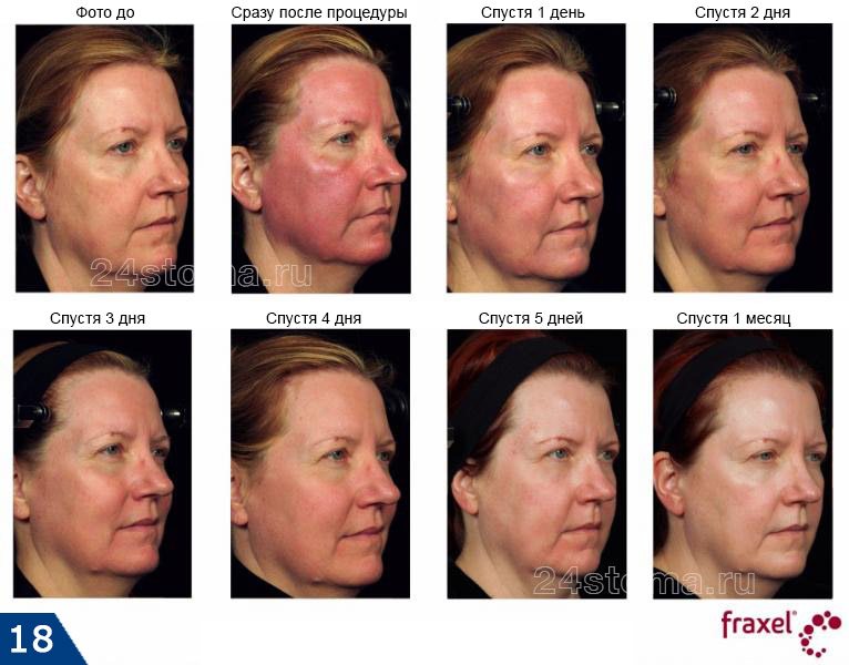 Состояние кожи лица до процедуры Фраксель и после процедуры в динамике
