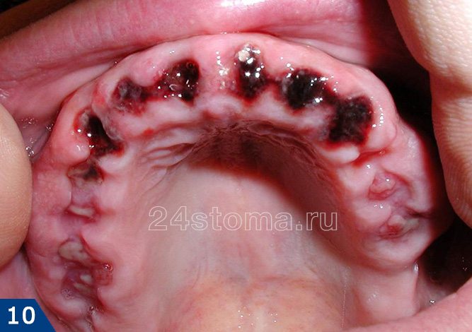 Вид лунок удаленных шести передних зубов на следующий день после удаления