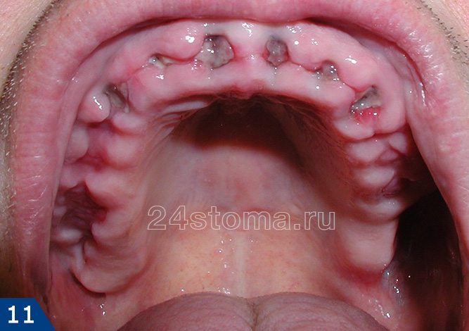 Вид лунок удаленных шести передних зубов через 7 дней после удаления