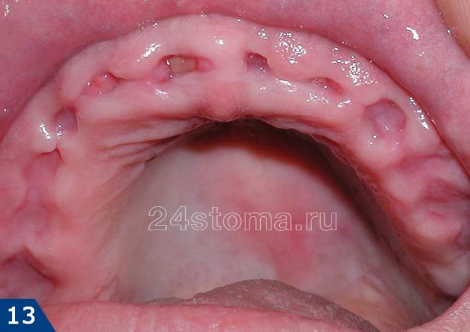 Вид лунок удаленных шести передних зубов через 20 дней после удаления