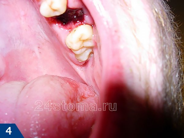 Вид лунки удаленного зуба сразу после того, как был убран марлевый тампон